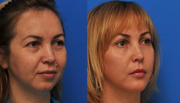 before and after skin rejuvenation with firming photo 1