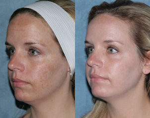 Photo before and after the fractional rejuvenation of the face