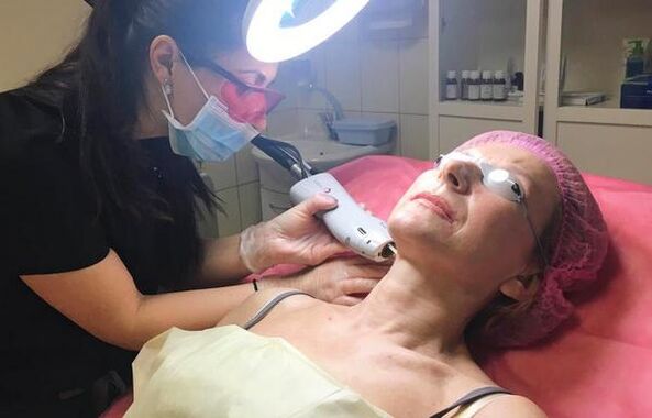 laser rejuvenation of the neckline area