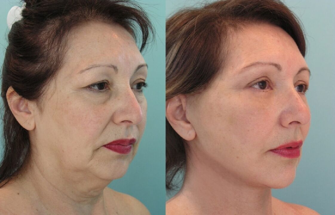 Before and after thread lift