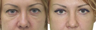 Photos before and after the eyelid contour